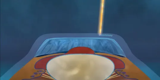 flap-creation-in-intralase